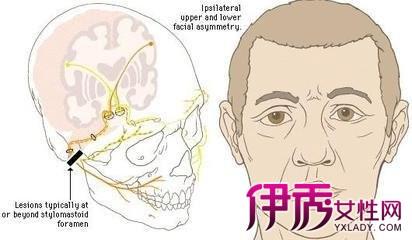 面部神经麻木 面部神经麻木-概述，面部神经麻木-原因