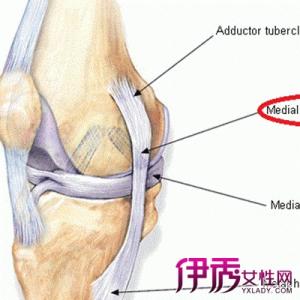 膝关节内侧副韧带断裂 膝关节内侧副韧带断裂-病因，膝关节内侧副