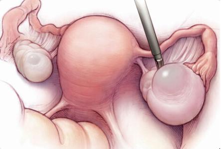 卵巢癌晚期能活多久 卵巢癌晚期症状
