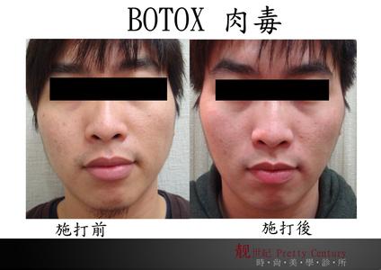 BOTOX BOTOX-基本简介，BOTOX-注射等级