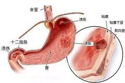 胃溃疡 胃溃疡-病因病机，胃溃疡-临床表现