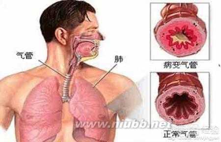 支气管扩张的典型表现 支气管扩张的典型症状