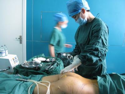 吸脂手术原理 吸脂手术 吸脂手术-吸脂手术的原理，吸脂手术-吸脂手术的适应症