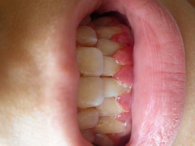 牙龈红肿怎么快速消肿 牙龈红肿怎么办