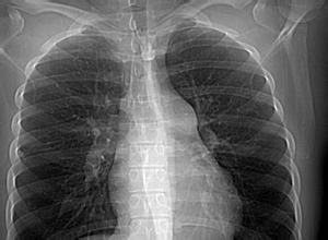 两肺纹理增多严重吗 肺纹理增多是怎么回事