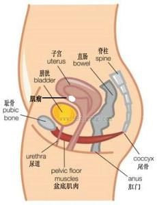 子宫肌瘤 子宫肌瘤-概述，子宫肌瘤-早期症状