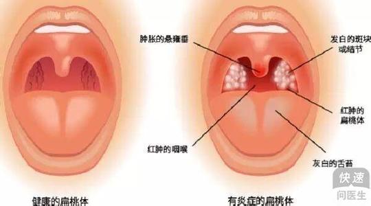 扁桃体发炎怎么好得快 扁桃体发炎能吃什么