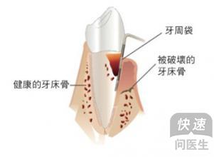 牙周炎不能吃什么食物 青少年牙周炎吃什么食物有益