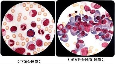 多发性骨髓瘤会遗传吗 多发性骨髓瘤的症状