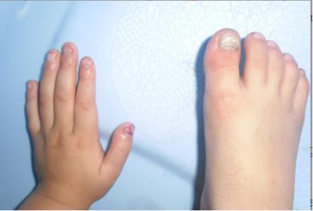 灰指甲的治疗方法 什么是灰指甲灰指甲怎么办
