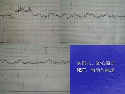 Nst无刺激胎心监护 Nst无刺激胎心监护-NST评分方法 ，Nst无刺激