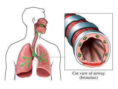 支气管炎吃什么药 支气管炎如何根治