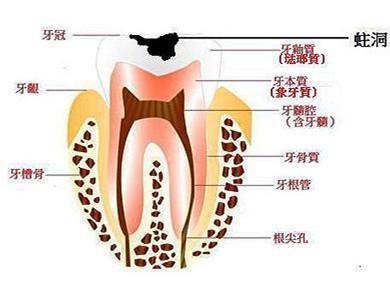 急性牙髓炎症状 急性牙髓炎有哪些症状