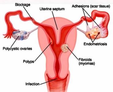 子宫移植 子宫移植-适应症，子宫移植-供体