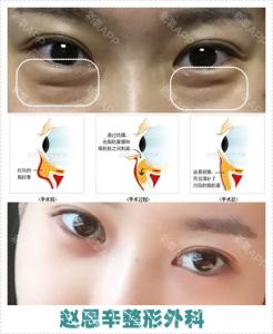 黑眼圈去除术 黑眼圈去除术-概述，黑眼圈去除术-形成原因