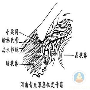 青光眼手术后吃什么好 青光眼手术后有什么禁忌？