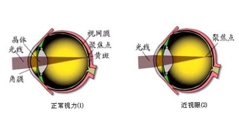 近视的原因有哪些 近视的原因有哪些呢？