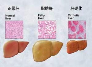 治疗重度脂肪肝的偏方 重度脂肪肝的治疗方法