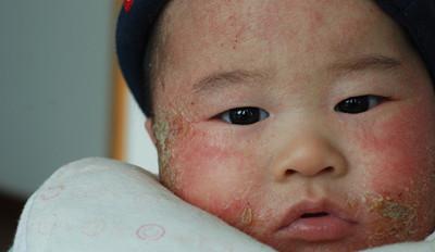 婴儿湿疹 婴儿湿疹-概述，婴儿湿疹-病因