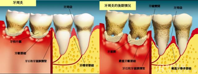 牙周炎 牙周炎-病因，牙周炎-临床表现