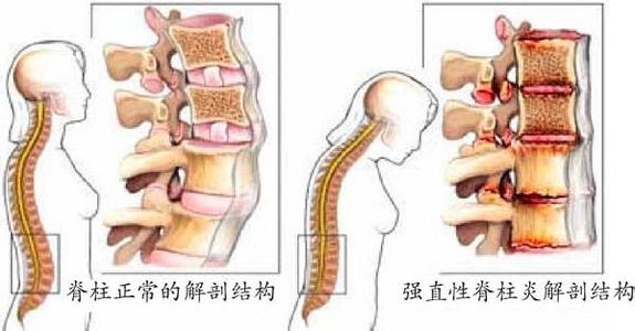 强直性脊柱炎 虹膜炎 怎样判断强直性脊柱炎并发症虹膜炎的症状和预防