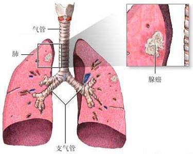 肺癌肝转移治疗 肺癌肝转移治疗-肺癌肝转移综合治疗，肺癌肝转移