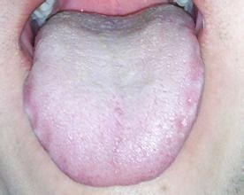 舌苔厚白是怎么治疗 舌苔厚白是怎么办