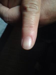 怎样消除指甲上的竖纹 指甲有竖纹的成因及治疗方法