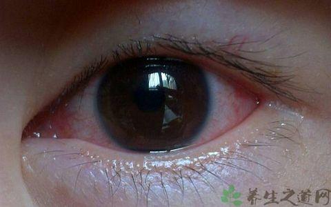 眼睛红血丝是什么病 眼睛红血丝原因