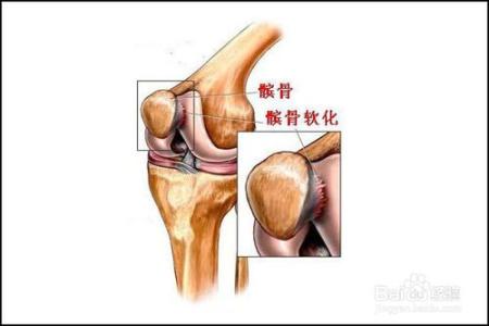 膝盖疼是怎么治疗方法 膝盖疼是怎么回事，膝盖疼的治疗方法