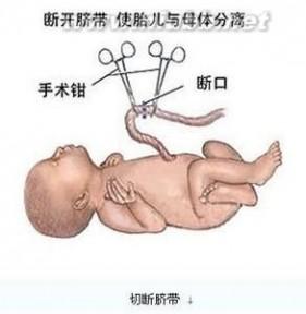 剖宫产 剖宫产-简介，剖宫产-起源