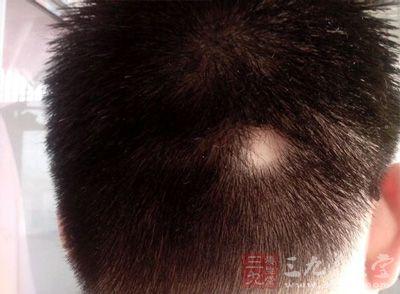 男性斑秃原因及治疗 男性斑秃怎么办