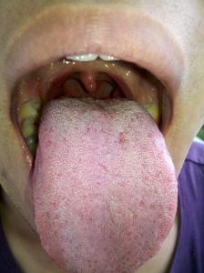 舌苔发白是什么原因呢 舌苔发白的原因