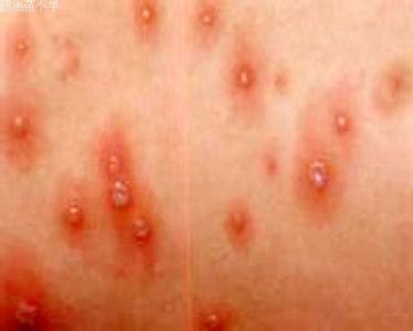 生水痘的前期症状 水痘的症状和治疗？怎么预防水痘？