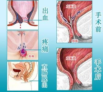 内痔疮最佳治疗方法 内痔疮的症状・内痔疮的最佳治疗方法