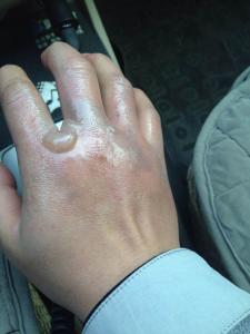 手指被烫伤了怎么处理 手被烫伤怎么处理