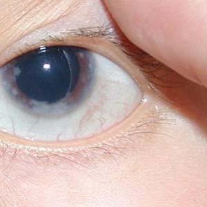 青光眼可以治愈吗 青光眼早期症状