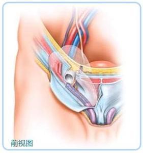 疝气图片 疝气是什么病