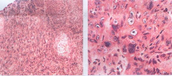 鳞状细胞癌 鳞状细胞癌-概述，鳞状细胞癌-病因