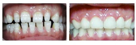 牙列稀疏 牙列稀疏-诊断，牙列稀疏-治疗
