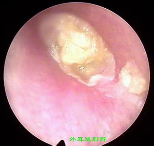 耵聍栓塞 耵聍栓塞-简要介绍，耵聍栓塞-症状体征