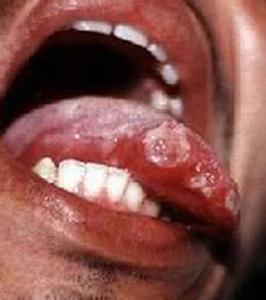 口腔溃疡的症状图片 口腔溃疡的症状
