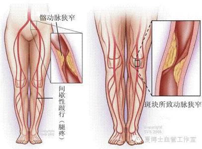 下肢干性坏疽的结局 下肢干性坏疽