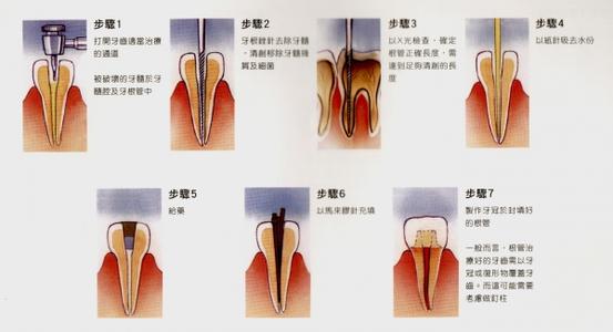 根管治疗 根管治疗 根管治疗-适应证，根管治疗-治疗介绍