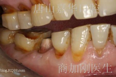 牙齿楔状缺损 牙齿楔状缺损 牙齿楔状缺损-病因病理病机，牙齿楔状缺损-临床表