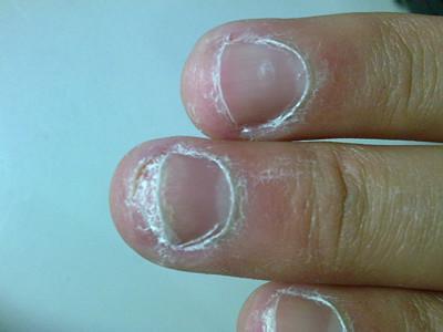 灰指甲图片 灰指甲的原因有哪些