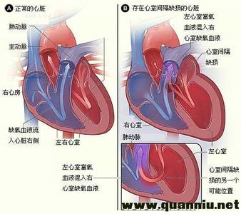 先天性心脏病分类 先天性心脏病 先天性心脏病-简介，先天性心脏病-分类