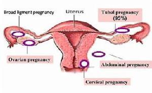 异位妊娠 异位妊娠-基本资料，异位妊娠-病因病理