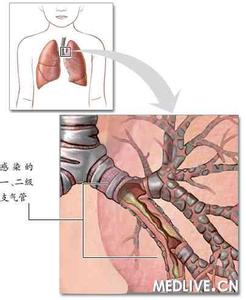 急性支气管炎 急性支气管炎-原因，急性支气管炎-病理生理