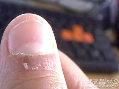 有蛔虫的症状指甲图片 有蛔虫的症状